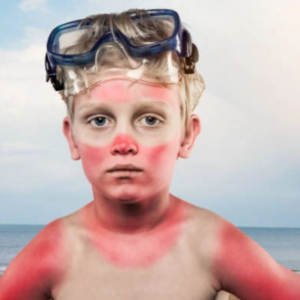 Child with severe sunburn wearing goggles on head at the beach.