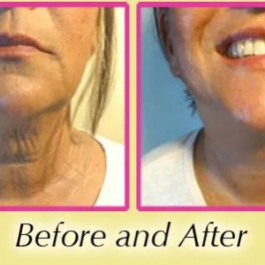 Close-up before and after image showing neck improvement.